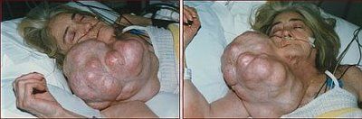 worlds-heaviest-neck-tumor_49.jpg