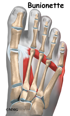 foot_bunionette_intro01.jpg