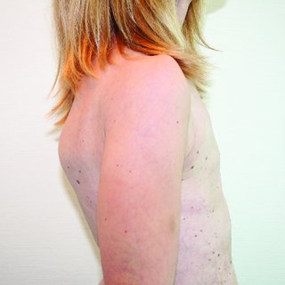 Preoperative-lateral-view-showing-total-absence-of-the-mammary-mound_Q320.jpg