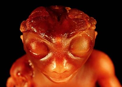 anencephaly_front.jpg