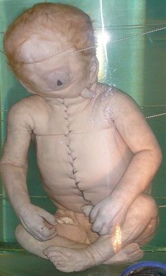 child_with_cyclopia.jpg