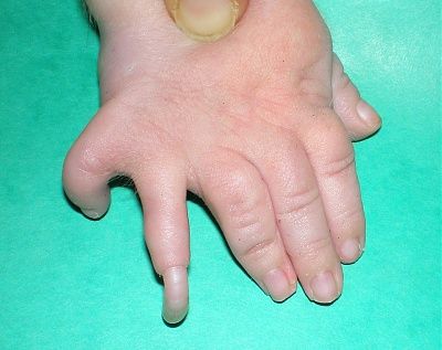 cornelia_de_lange_syndrome_3_080114.jpg