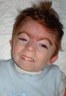 cornelia_de_lange_syndrome_4_080114.jpg