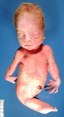 jpg_10516_sirenomelia_ectrodactyly_1-2.jpg