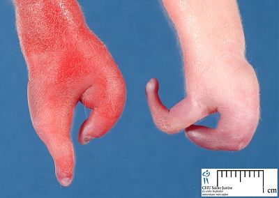 jpg_12772_ectrodactyly_cardiac_malformation_3-2.jpg