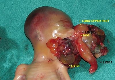 parasitic_conjoined_twins_doa.jpg