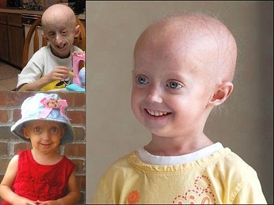 progeria.jpg
