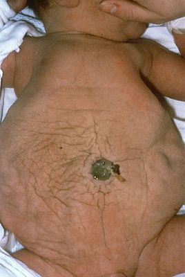 prune-belly.jpg