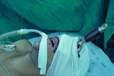stab-wound-face-1.jpg