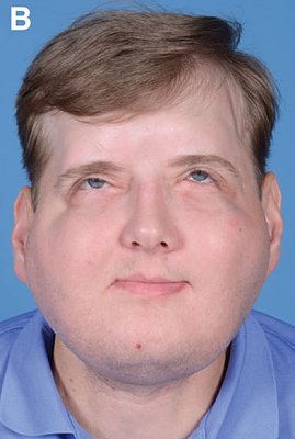 full-facial-total-scalp-burn-injury-2.jpg