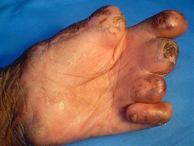 leprosy_1_040502.jpg