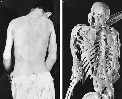 Fibrodysplasia%20Ossificans%20Progressiva.png