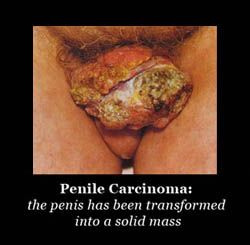 penile_cancer_small.jpg