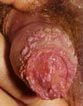 Warts-1.jpg