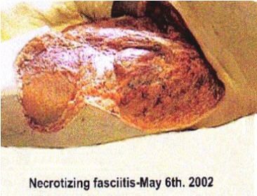 Necrotizing%20Fasciitis%2B%202002.jpg