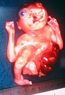 deformed_fetus.jpg