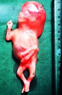 nuchal_translucency_cystic_hygroma.jpg