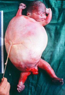foetal_ascitis.jpg