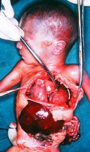 diaphramatic_hernia.jpg