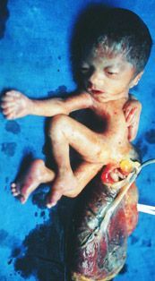 congenital_anomaly.jpg