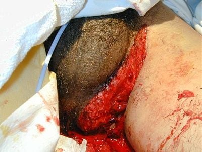 compound_open_book_pelvic_fracture.jpg