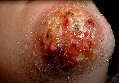 ringworm.jpg