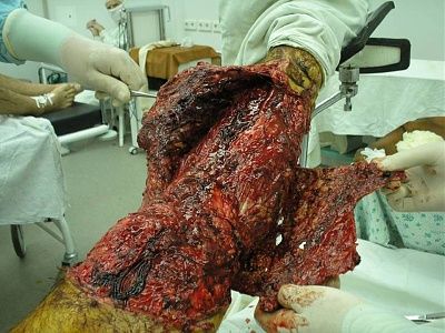 12632-horrifically-burned-legbig0.jpg