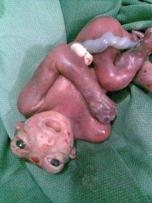 enencephaly.jpg