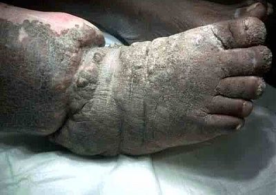 charonboat_dot_com_surgery_for_elephantiasis_1.jpg