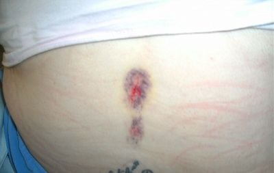 croppedbruise1.jpg
