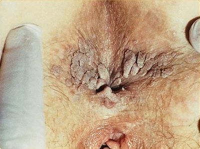 soa-condylomata-acuminata-around-anus.jpg