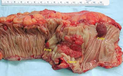 Advanced-Bowel-Cancer-And-Prognosis.jpg