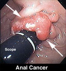 imgAnalCancer.jpg