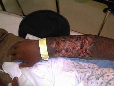 chronic-arm-ulceration-ivdu2.1.jpg