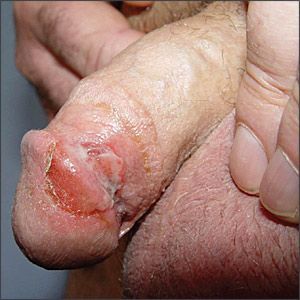 penis injury.jpg