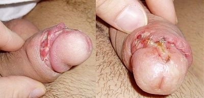 bitten-off-penis.jpg