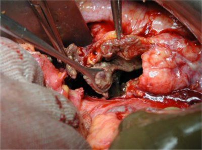 acute-pancreatitis-surgery-shot.jpg