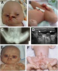 Bartsocas-Papas Syndrome (Bartsocas Papas Syndrome): Lethal Popliteal Pterygium - download%20%281%29