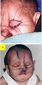 Bartsocas-Papas Syndrome (Bartsocas Papas Syndrome): Lethal Popliteal Pterygium - download%20%282%29