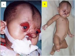 Bartsocas-Papas Syndrome (Bartsocas Papas Syndrome): Lethal Popliteal Pterygium - download%20%283%29