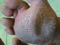 pitted-keratolysis-2z.jpg