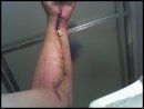 7 days after surgery.jpg