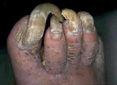 overgrown-toenails.jpg