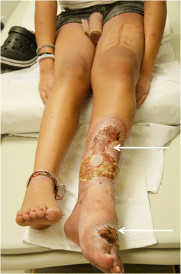 Clinical-photograph-of-Parkes-Weber-syndrome-in-a-14-year-old-girl-initially-diagnosed.png