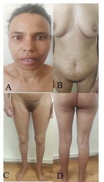 fahr-syndrome-secondary-to-hypoparathyroidism-with-dermatological-revelation.pdf-image-004.jpg