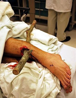 stick-leg-1-rs.jpg