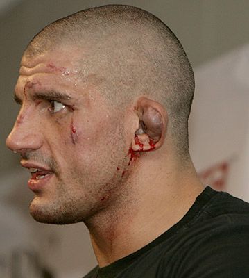 james_thompson_cauliflower_ear2.jpg