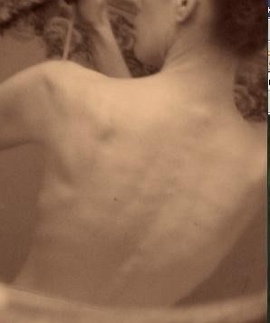 anorexia6.JPG