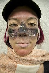 frostbite7.jpg