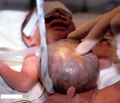 goregasm-dot-com-omphalocele2.jpg
